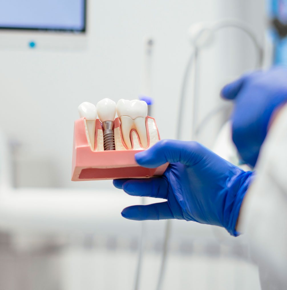 Dental implant model