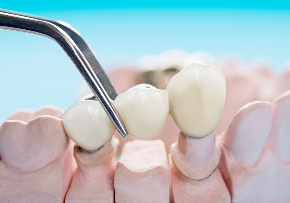 Dental bridge