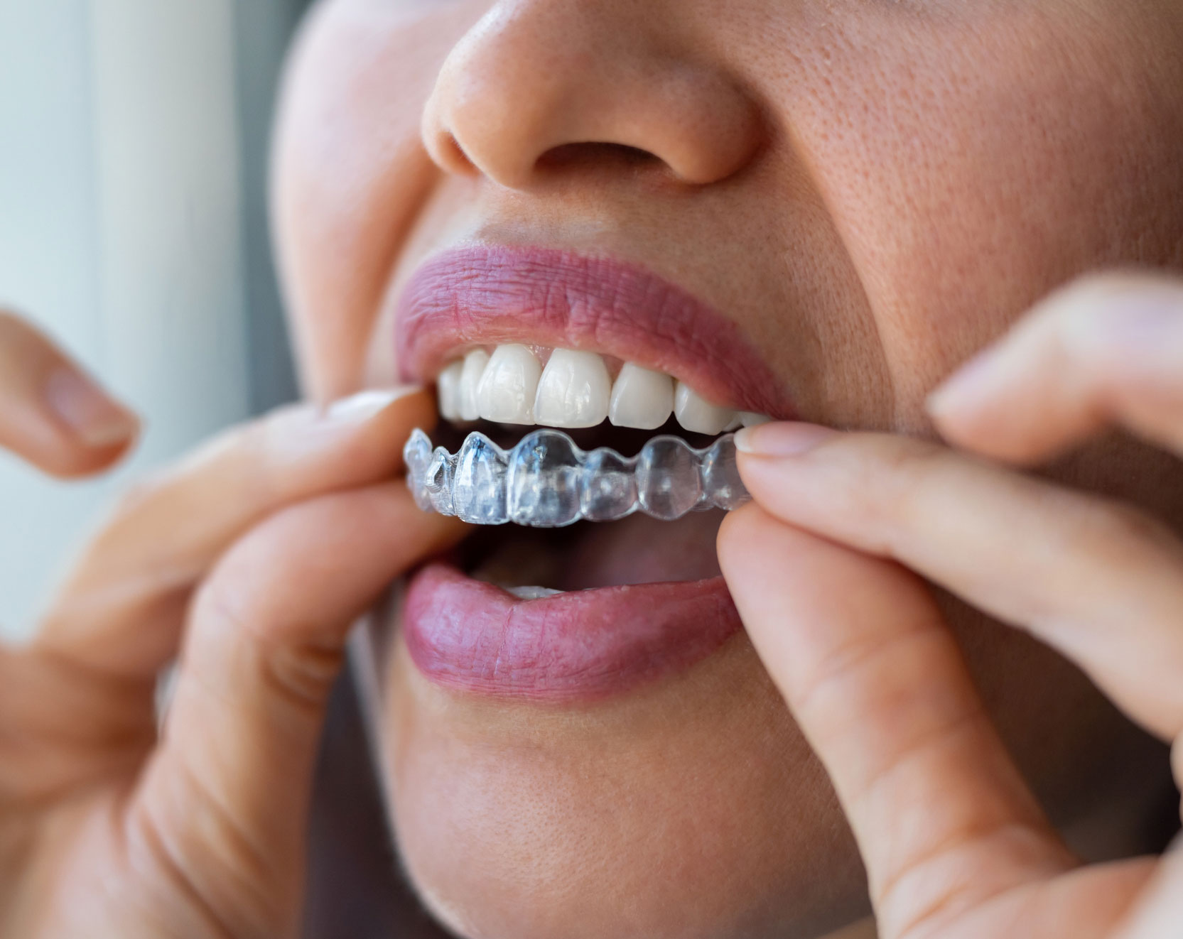 Teeth Straightening