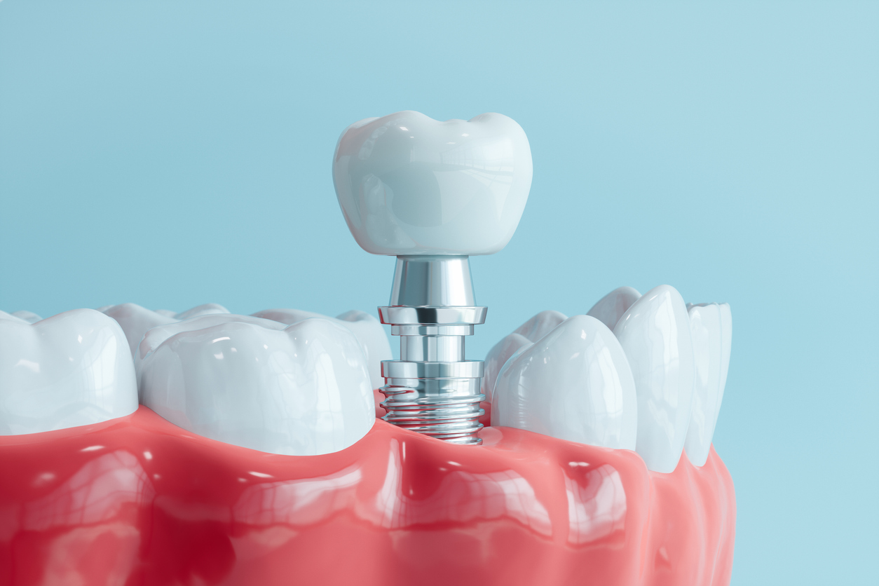 Are dental implants worth it compared to dentures?